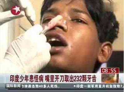 世上最奇怪的6大牙齿盘点:多长了232颗牙齿的少年 世上最奇怪的6大牙齿盘点:多长了232颗牙齿的少年