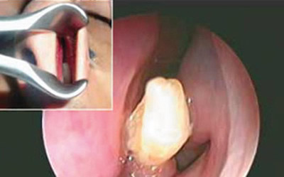 世上最奇怪的6大牙齿盘点:多长了232颗牙齿的少年
