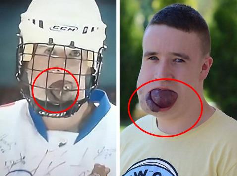 小伙舌大如球 睡觉或因窒息致死