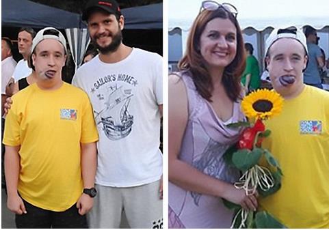 小伙舌大如球 睡觉或因窒息致死