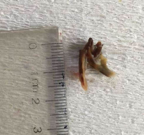 男子咳嗽两年治不好只因这物! 男子咳嗽两年治不好只因这物!