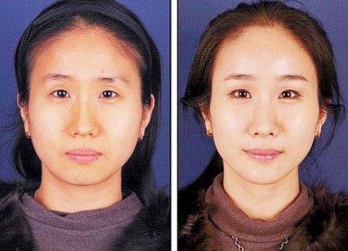 【什么是微笑手术】韩国流行的嘴部整形手术 【什么是微笑手术】韩国流行的嘴部整形手术