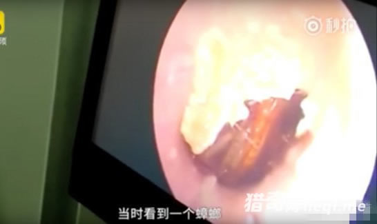 睡梦中被痛惊醒去医院竟取出它