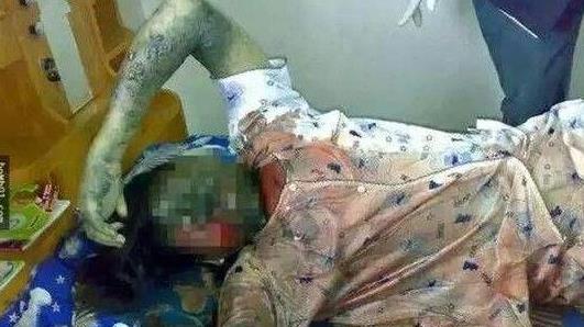 女子床上凄惨一幕!惊呆众人(上半身被烧焦发黑) 女子床上凄惨一幕!惊呆众人(上半身被烧焦发黑)