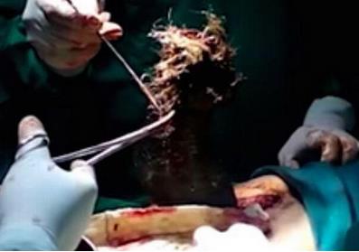 异食癖人玻璃石头汽油均在列 异食癖人玻璃石头汽油均在列