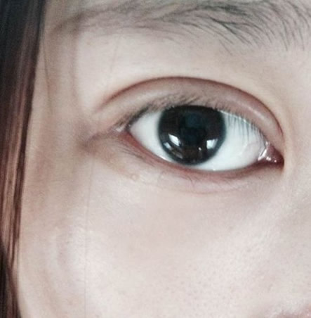 做双眼皮的最佳年龄:可以做双眼皮手术最佳年龄 做双眼皮的最佳年龄:可以做双眼皮手术最佳年龄