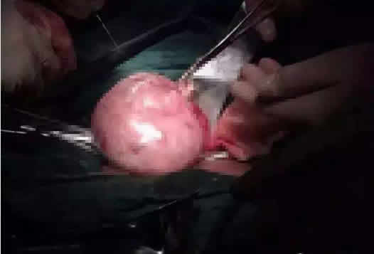 长了30年的瘤子切开后竟是这样 长了30年的瘤子切开后竟是这样