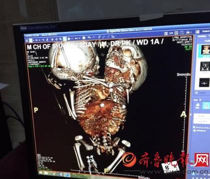 揭秘世界上最长寿的连体婴(图文) 揭秘世界上最长寿的连体婴(图文)