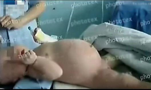 七个月男婴竟怀孕 剖腹产下一女婴:喊人听闻 七个月男婴竟怀孕 剖腹产下一女婴:喊人听闻