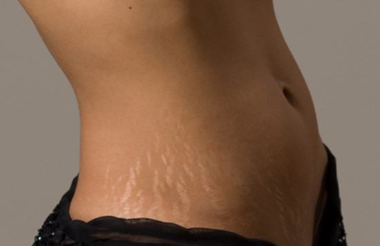 【产后去妊娠纹】产后怎样消除妊娠纹 去除妊娠纹的最好方法 【产后去妊娠纹】产后怎样消除妊娠纹 去除妊娠纹的最好方法