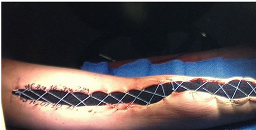 手有小块红肿隔天竟被吃掉一半（图文）