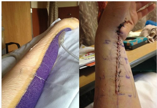 手有小块红肿隔天竟被吃掉一半（图文）