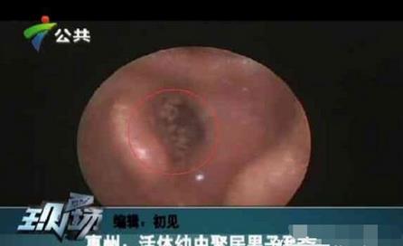 男子耳朵奇痒无比里面竟有这个(图) 男子耳朵奇痒无比里面竟有这个(图)
