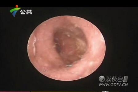 男子耳朵奇痒无比里面竟有这个(图) 男子耳朵奇痒无比里面竟有这个(图)