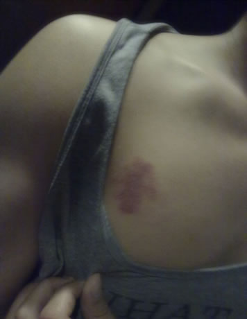 被种草莓是什么意思：种草莓的吻痕图片部位