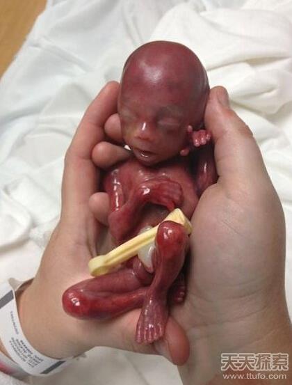 胎儿早产去世 小生命吓傻家人（不喜误入）