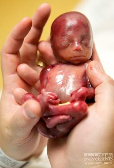 胎儿早产去世 小生命吓傻家人（不喜误入）