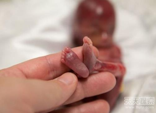 胎儿早产去世 小生命吓傻家人（不喜误入）