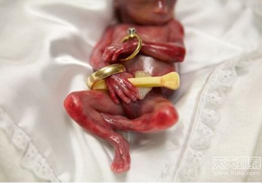 胎儿早产去世 小生命吓傻家人（不喜误入）