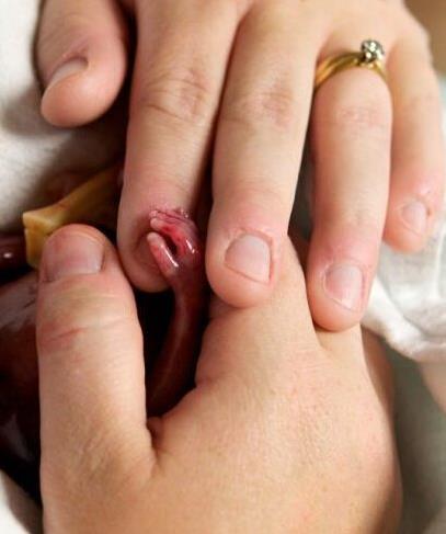 胎儿早产去世 小生命吓傻家人（不喜误入）