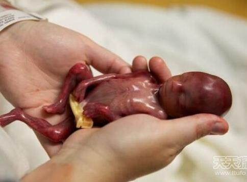 胎儿早产去世 小生命吓傻家人（不喜误入）