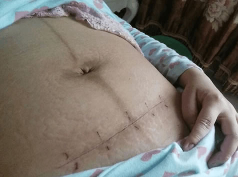 女子3次剖腹 打开肚子医生惊恐（图）