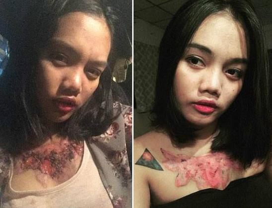 女大学生除胸前纹身被坑:不料留下触目惊心的疤痕 女大学生除胸前纹身被坑:不料留下触目惊心的疤痕