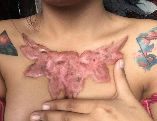 女大学生除胸前纹身被坑：不料留下触目惊心的疤痕