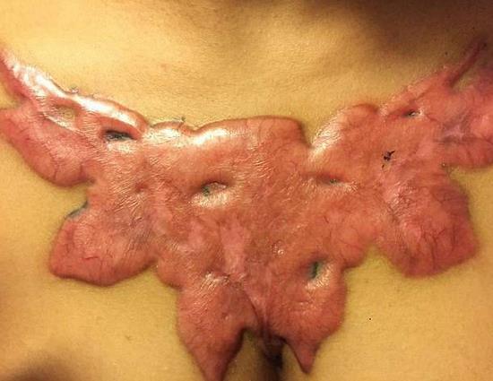 女大学生除胸前纹身被坑：不料留下触目惊心的疤痕