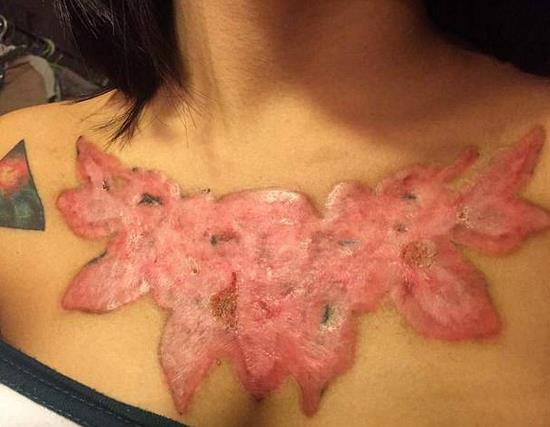 女大学生除胸前纹身被坑：不料留下触目惊心的疤痕