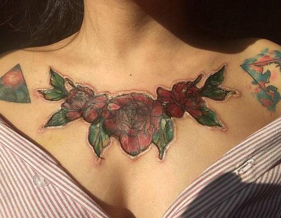 女大学生除胸前纹身被坑：不料留下触目惊心的疤痕