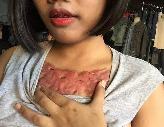 女大学生除胸前纹身被坑：不料留下触目惊心的疤痕