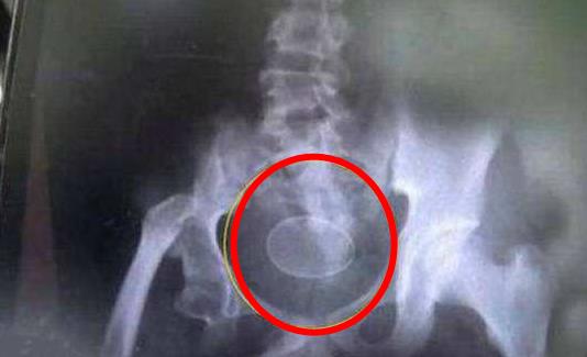 男童肛门竟产下蛋 专家鉴定确有其事（组图）