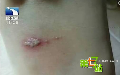 女子睡梦中拍蚊子醒来后已毁容（图）