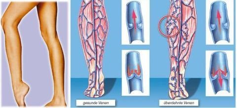 以为脚是静脉曲张 医生诊断后傻眼（全文）