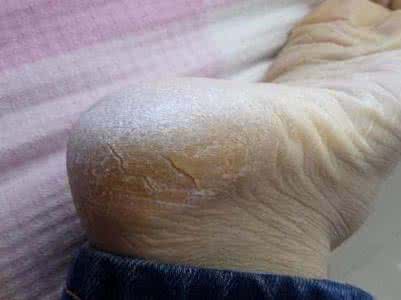 脚后跟干裂怎么办：脚后跟干裂的原因及防止方法介绍