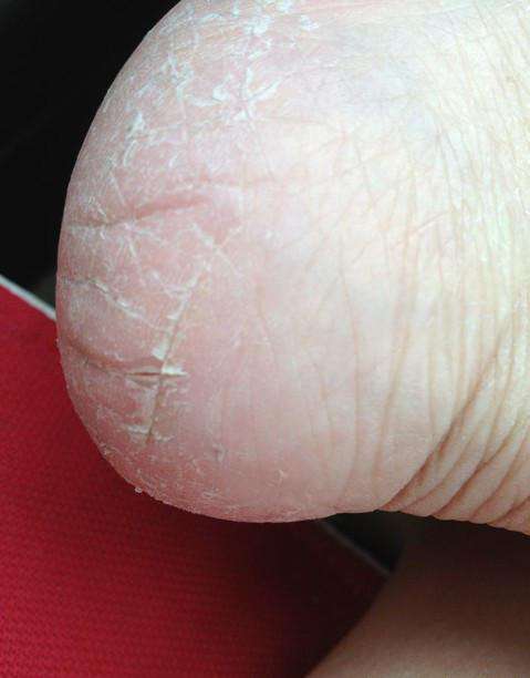 脚后跟干裂怎么办：脚后跟干裂的原因及防止方法介绍