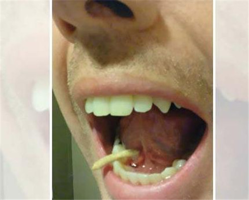 牙痛去检查 3厘米"怪虫"从舌下钻出(组图)