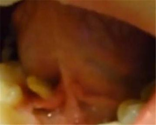 牙痛去检查 3厘米怪虫从舌下钻出（组图）