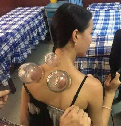 拔罐的好处和坏处：拔罐的作用详情全解析