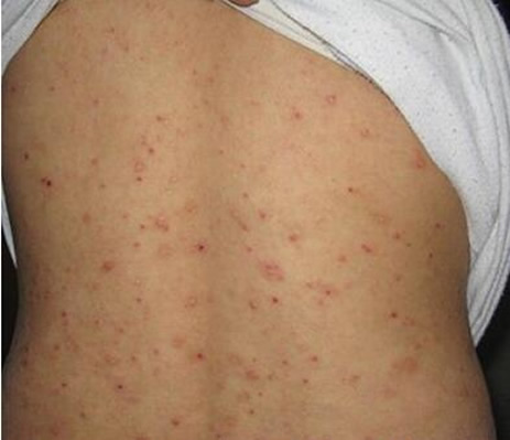 症状图片:疥疮是由疥螨在人体皮肤表皮层内引起的接触性传染性皮肤病
