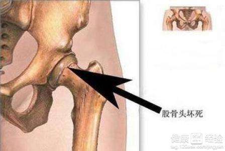 股骨头坏死早期治疗：股骨头坏死早期治疗方法有什么