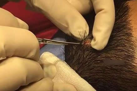 划开头皮竟长出这么可怕的东西(图) 划开头皮竟长出这么可怕的东西(图)