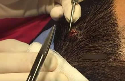 划开头皮竟长出这么可怕的东西(图) 划开头皮竟长出这么可怕的东西(图)