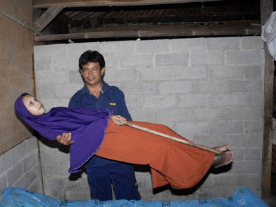 罕见怪病！女子全身像木头一样硬（图）