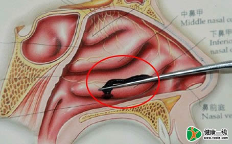 女子腿疼难忍竟从体内取出它（图）
