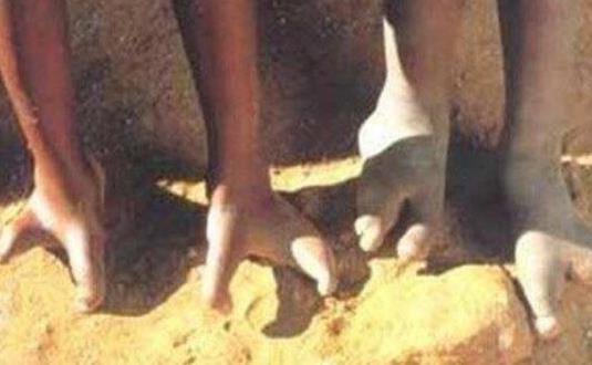 非洲鸵鸟人只有两个脚趾：全族都有螯虾综合症（图）