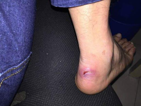 伤口化脓怎么处理：介绍几种正确的处理方法（图）