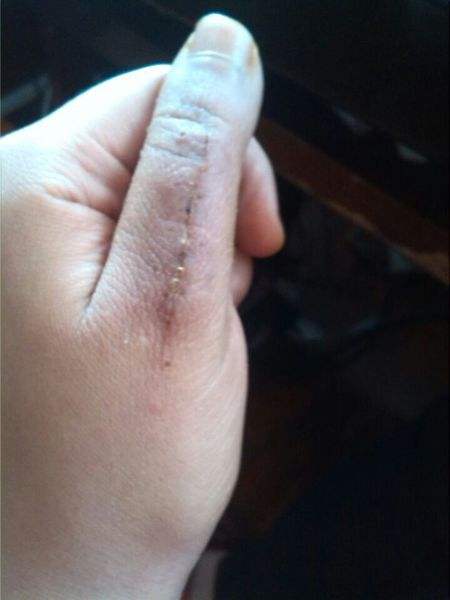 伤口化脓怎么处理：介绍几种正确的处理方法（图）