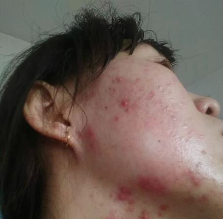 下巴长痘痘是什么原因：下巴长痘痘怎么办（图）